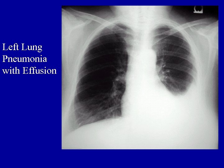 Left Lung Pneumonia with Effusion 
