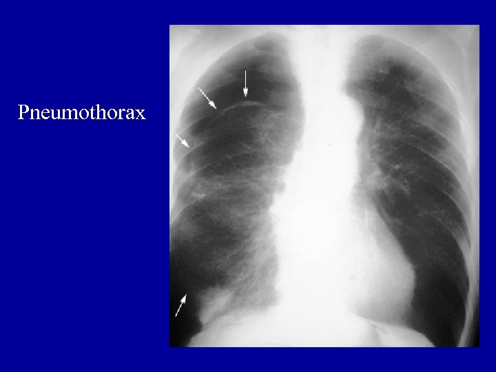 Pneumothorax 