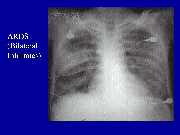 ARDS (Bilateral Infiltrates) 