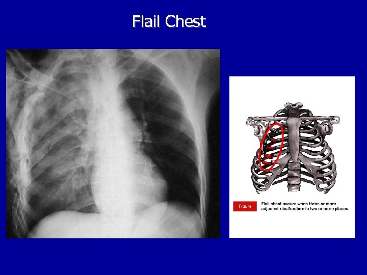Flail Chest 