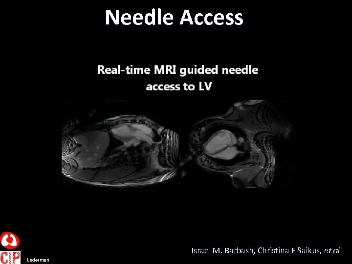 Needle Access Israel M. Barbash, Christina E Saikus, et al Lederman 