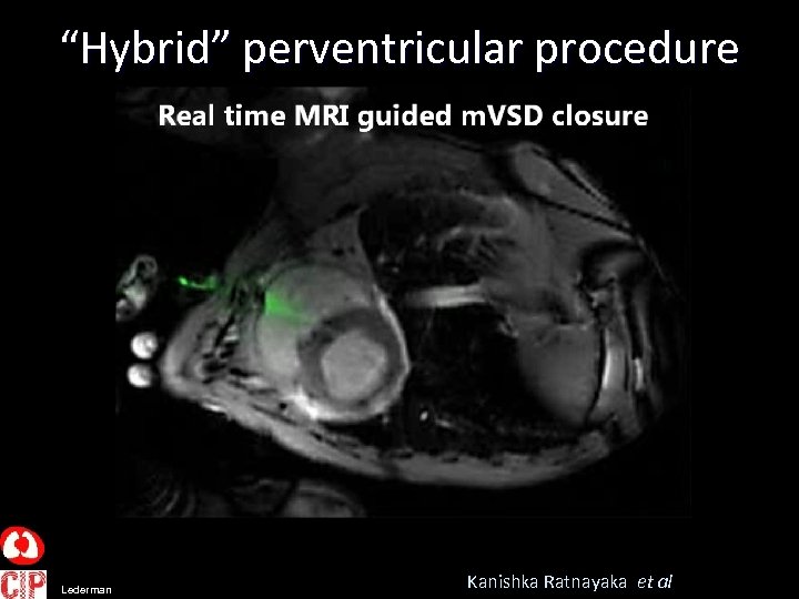 “Hybrid” perventricular procedure Lederman Kanishka Ratnayaka et al 