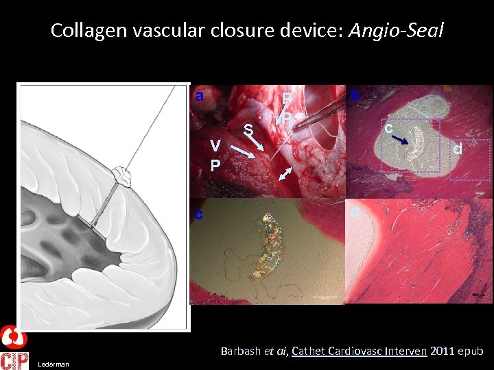 Collagen vascular closure device: Angio-Seal a V P c S P P b c
