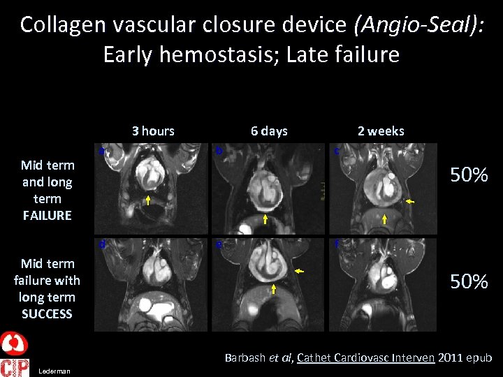 Collagen vascular closure device (Angio-Seal): Early hemostasis; Late failure 3 hours Mid term and