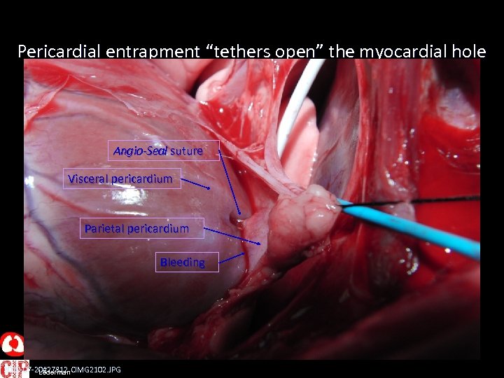 Pericardial entrapment “tethers open” the myocardial hole Angio-Seal suture Visceral pericardium Parietal pericardium Bleeding