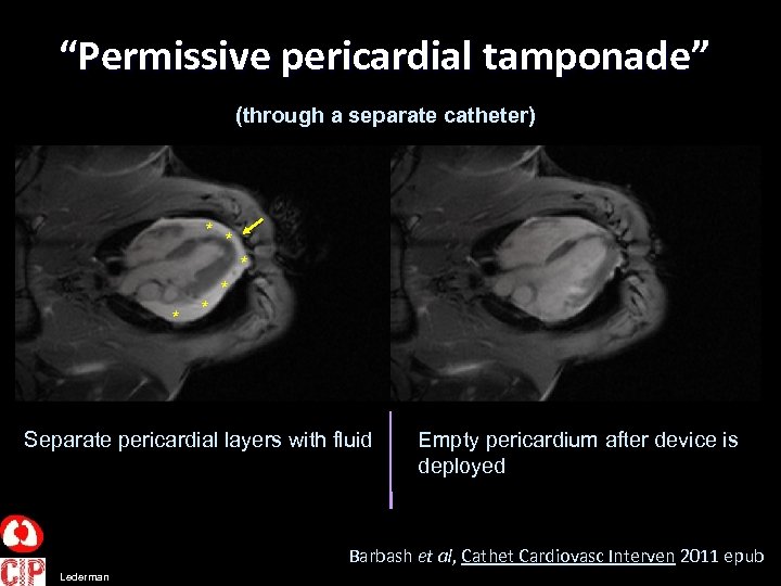 “Permissive pericardial tamponade” (through a separate catheter) * * * Separate pericardial layers with