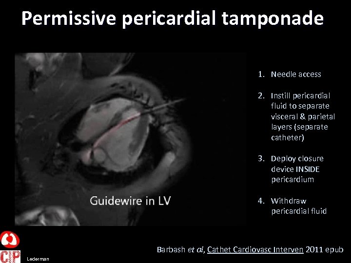 Permissive pericardial tamponade 1. Needle access 2. Instill pericardial fluid to separate visceral &