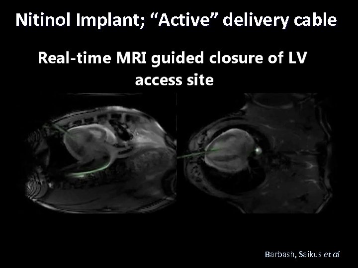 Nitinol Implant; “Active” delivery cable Barbash, Saikus et al Lederman 