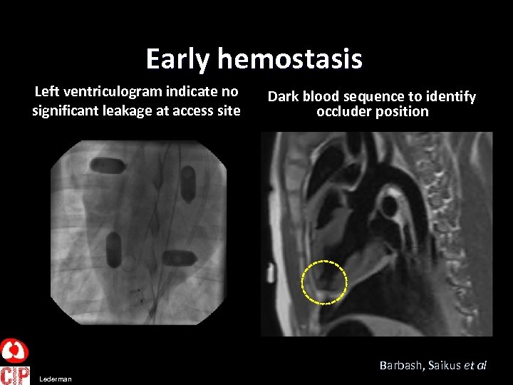 Early hemostasis Left ventriculogram indicate no significant leakage at access site Dark blood sequence