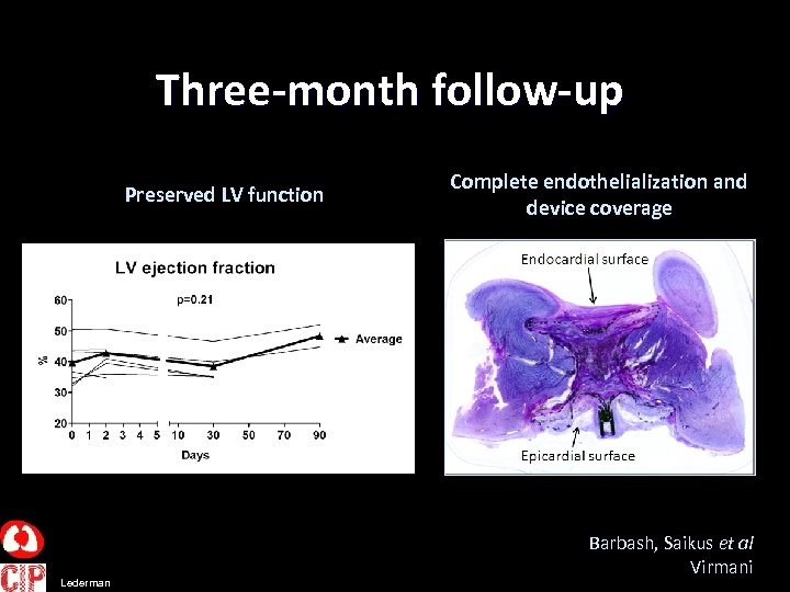 Three-month follow-up Preserved LV function Lederman Complete endothelialization and device coverage Barbash, Saikus et