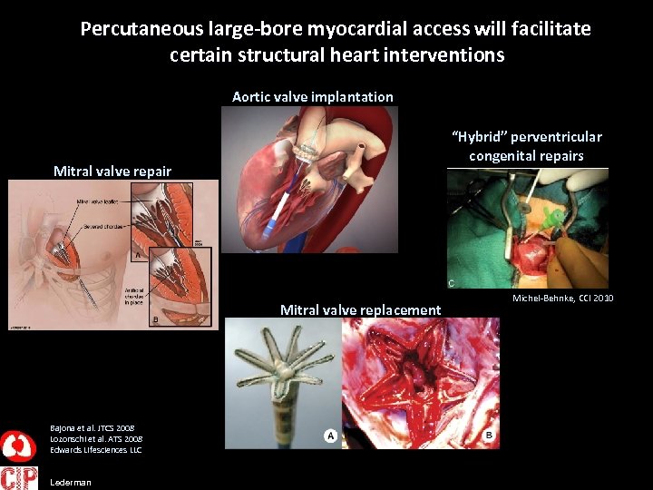 Percutaneous large-bore myocardial access will facilitate certain structural heart interventions Aortic valve implantation “Hybrid”