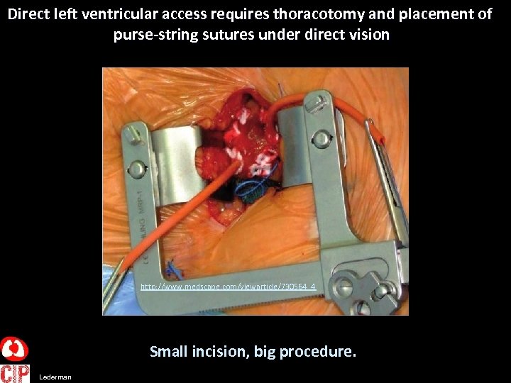 Direct left ventricular access requires thoracotomy and placement of purse-string sutures under direct vision
