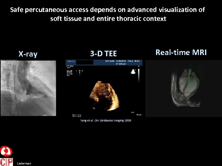 Safe percutaneous access depends on advanced visualization of soft tissue and entire thoracic context