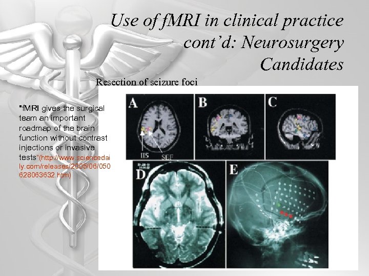 Use of f. MRI in clinical practice cont’d: Neurosurgery Candidates Resection of seizure foci