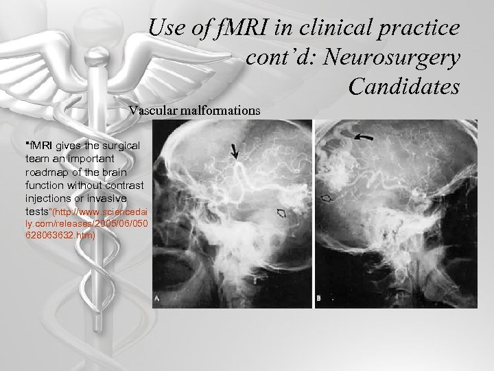 Use of f. MRI in clinical practice cont’d: Neurosurgery Candidates Vascular malformations 