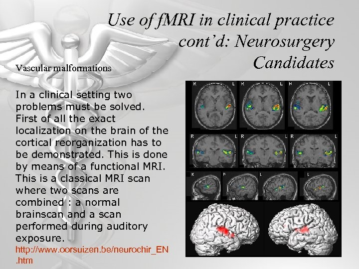 Use of f. MRI in clinical practice cont’d: Neurosurgery Candidates Vascular malformations In a