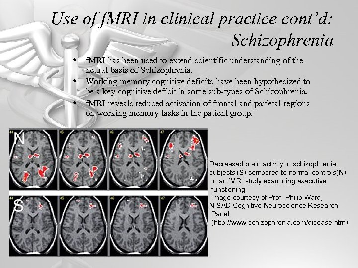 Use of f. MRI in clinical practice cont’d: Schizophrenia w f. MRI has been