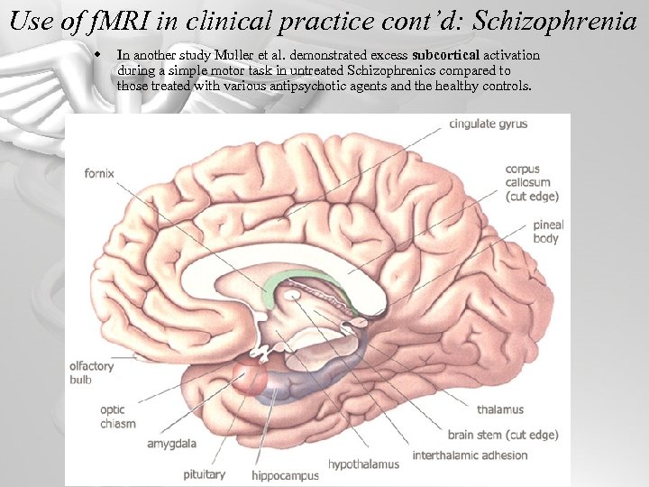 Use of f. MRI in clinical practice cont’d: Schizophrenia w In another study Muller
