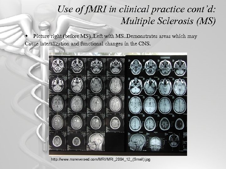 Use of f. MRI in clinical practice cont’d: Multiple Sclerosis (MS) w Picture right
