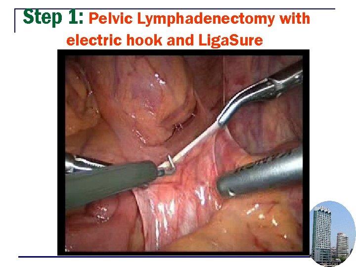 Step 1: Pelvic Lymphadenectomy with electric hook and Liga. Sure 