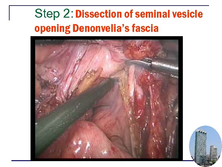 Step 2: Dissection of seminal vesicle opening Denonvelia’s fascia 