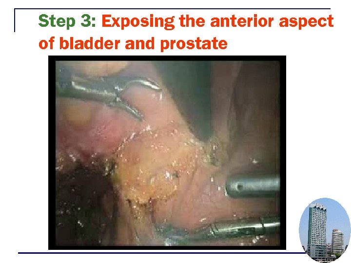 Step 3: Exposing the anterior aspect of bladder and prostate 