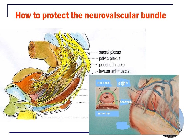 How to protect the neurovalscular bundle 