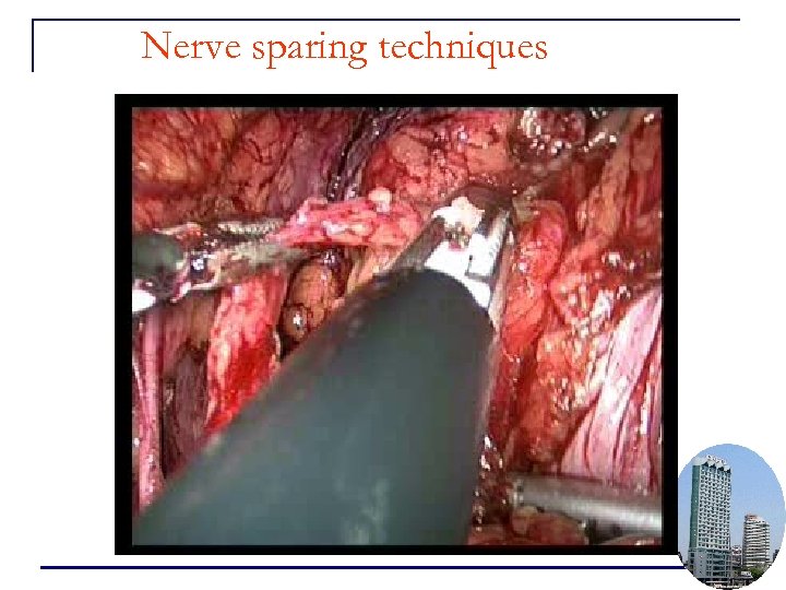 Nerve sparing techniques 