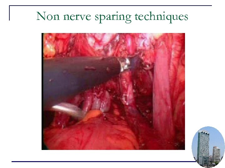 Non nerve sparing techniques 