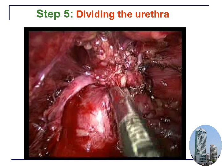 Step 5: Dividing the urethra 