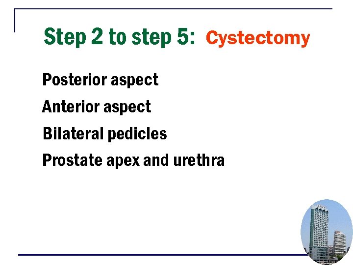 Step 2 to step 5: Cystectomy Posterior aspect Anterior aspect Bilateral pedicles Prostate apex