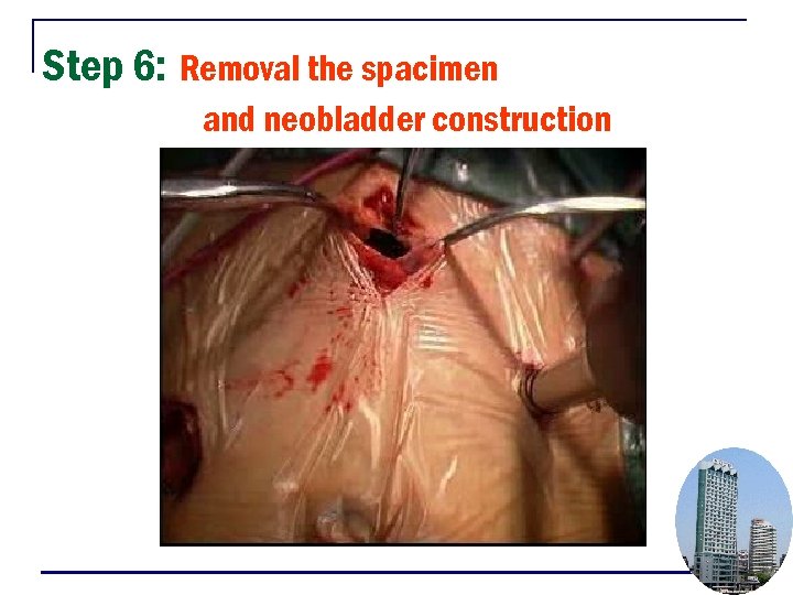 Step 6: Removal the spacimen and neobladder construction 