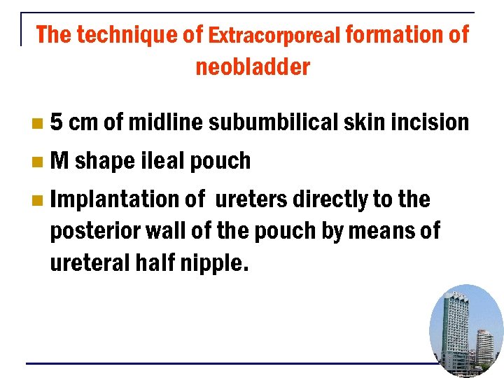 The technique of Extracorporeal formation of neobladder 5 cm of midline subumbilical skin incision