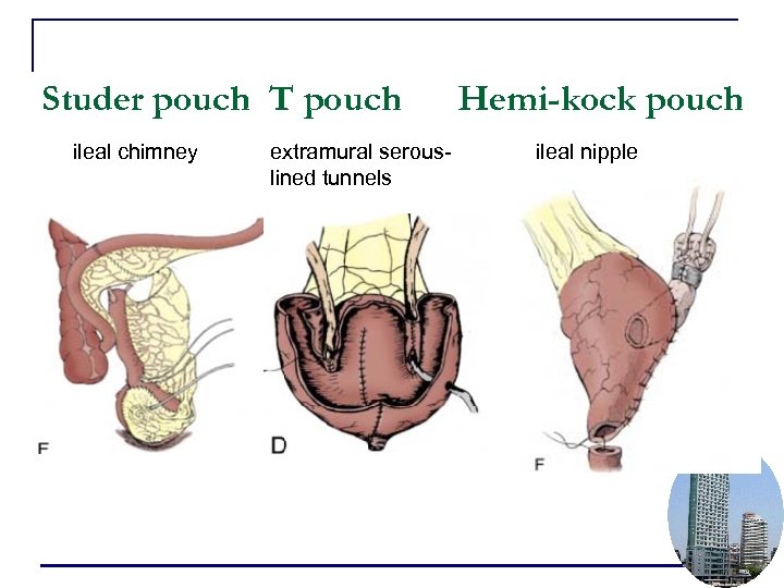 Studer pouch T pouch ileal chimney extramural serouslined tunnels Hemi-kock pouch ileal nipple 