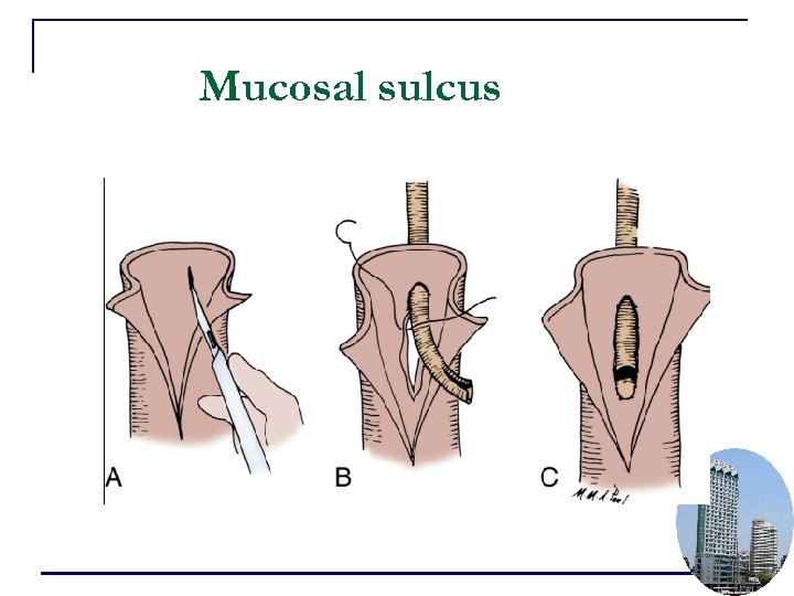 Mucosal sulcus 