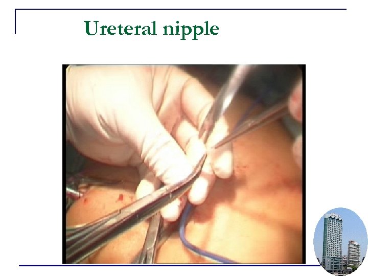 Ureteral nipple 