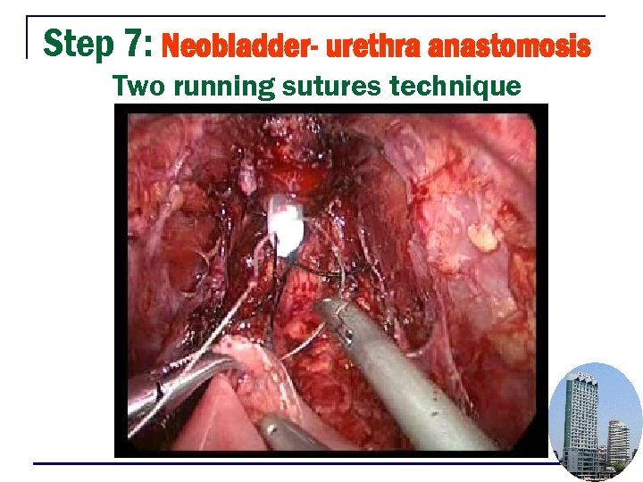 Step 7: Neobladder- urethra anastomosis Two running sutures technique 