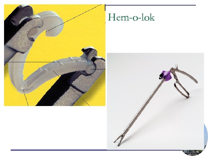 Hem-o-lok 