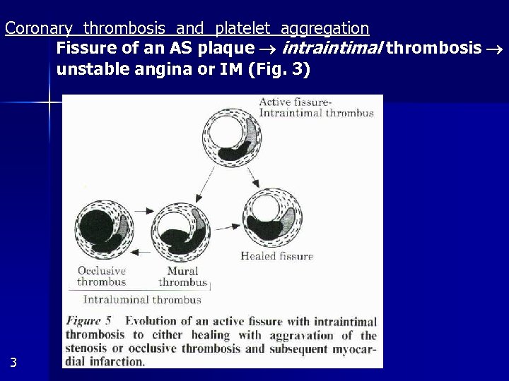 Coronary thrombosis and platelet aggregation Fissure of an AS plaque intraintimal thrombosis unstable angina