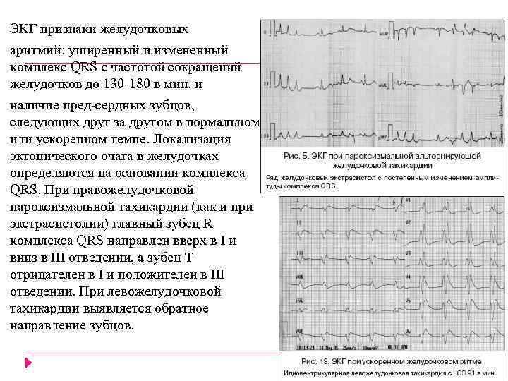 ЭКГ признаки желудочковых аритмий: уширенный и измененный комплекс QRS с частотой сокращений желудочков до