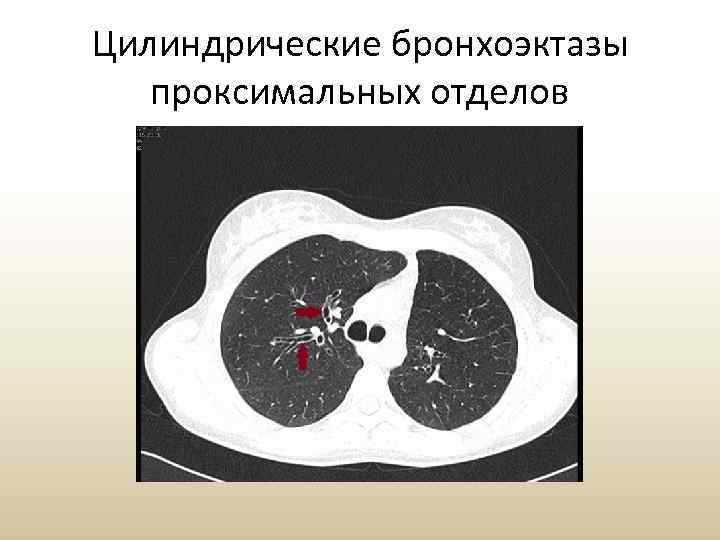 Цилиндрические бронхоэктазы проксимальных отделов 