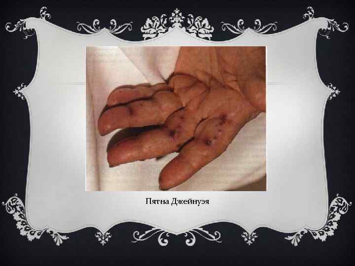 Пятна Джейнуэя 