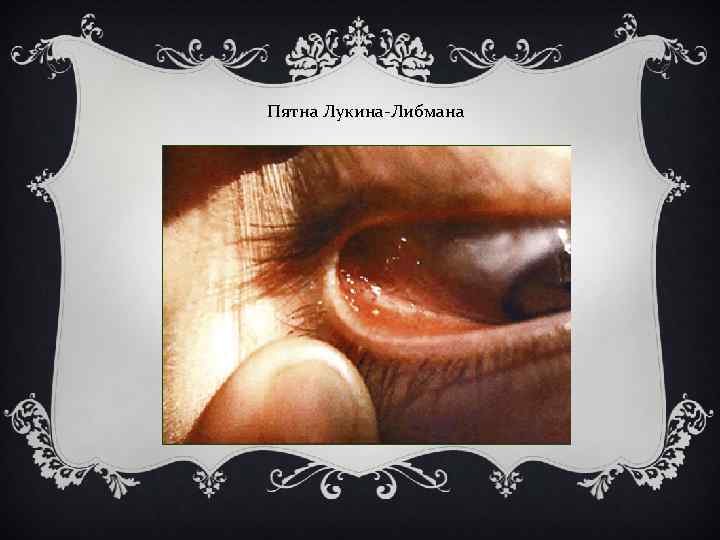 Пятна Лукина-Либмана 