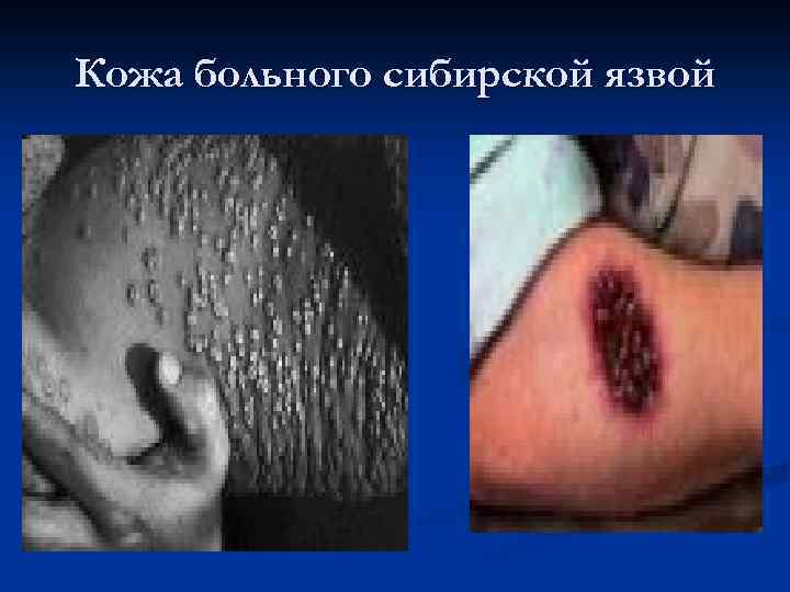 Кожа больного сибирской язвой 
