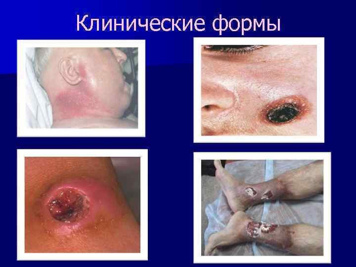 Клинические формы 