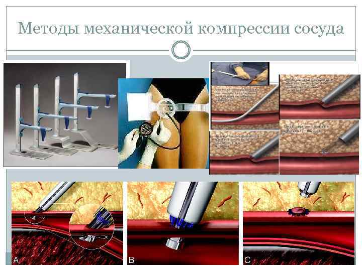 Методы механической компрессии сосуда 