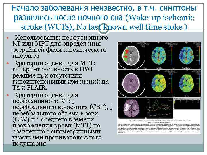 Начало заболевания неизвестно, в т. ч. симптомы развились после ночного сна (Wake-up ischemic stroke
