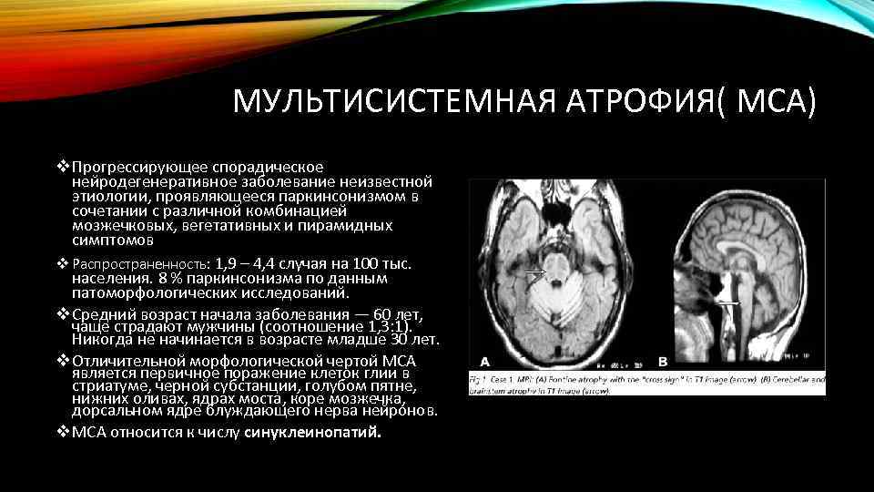 МУЛЬТИСИСТЕМНАЯ АТРОФИЯ( МСА) v Прогрессирующее спорадическое нейродегенеративное заболевание неизвестной этиологии, проявляющееся паркинсонизмом в сочетании