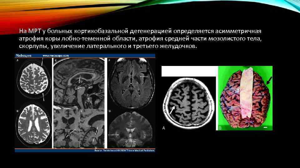 На МРТ у больных кортикобазальной дегенерацией определяется асимметричная атрофия коры лобно-теменной области, атрофия средней