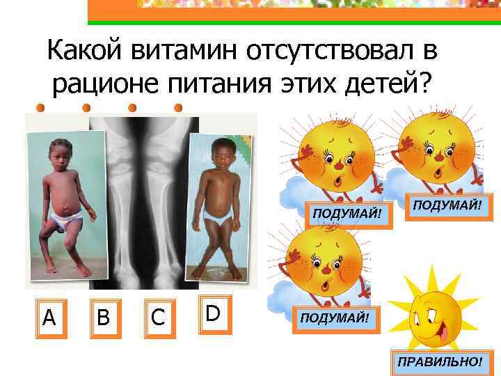 Какой витамин отсутствовал в рационе питания этих детей? ПОДУМАЙ! А В С D ПОДУМАЙ!